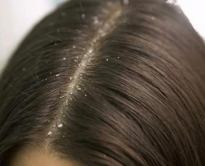 डैंड्रफ से छुटकारा पाने के लिए करें ये उपाय