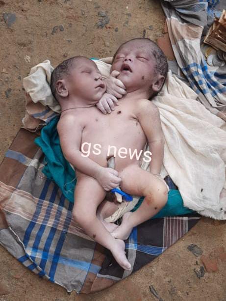 भागलपुर में अद्भुत बच्चे का जन्म, दो सर,चार हाथ, तीन पैर वाले बच्चे ने 30 मिनट बाद ही तोड़ा दम