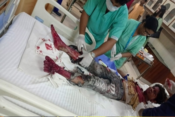 घर में पटाखा बना रहे दो भाई घायल, एक ने दोनों हाथ गंवाए