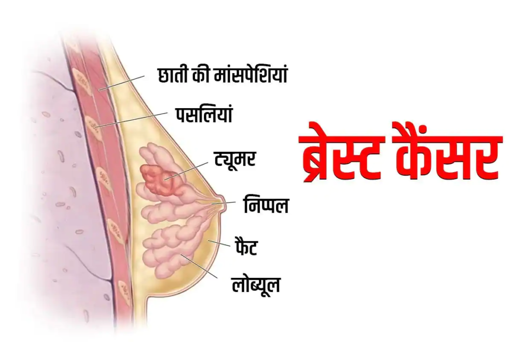 स्तन कैंसर: स्तन कैंसर क्या है, इसके लक्षण, कारण और इलाज के साथ ही जानिए जोखिम कारक