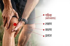 योग गठिया के रोगियों को राहत पहुंचा सकता है: एम्स